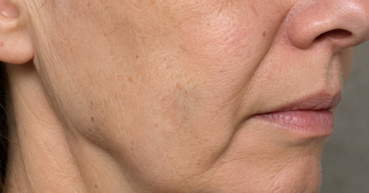 HIFU médico en medicina estética: tecnología avanzada para reafirmar y rejuvenecer la piel