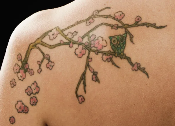 Eliminación de tatuajes con láser Q-Switched