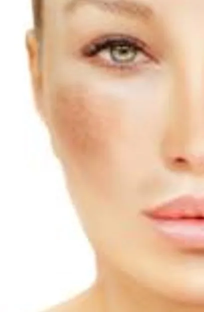 Tratamiento láser del melasma