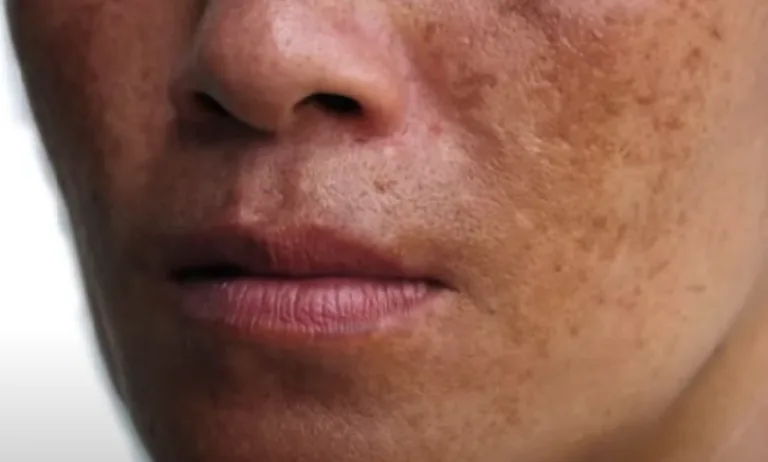 Tratamiento láser del melasma
